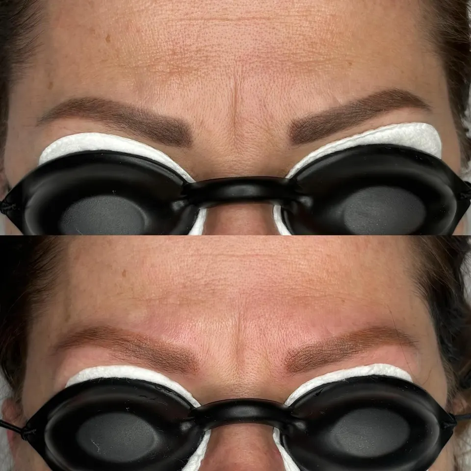 Laser removal of unwanted pigment