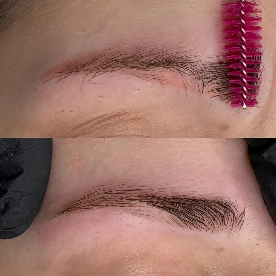 Laser brow removal in progress