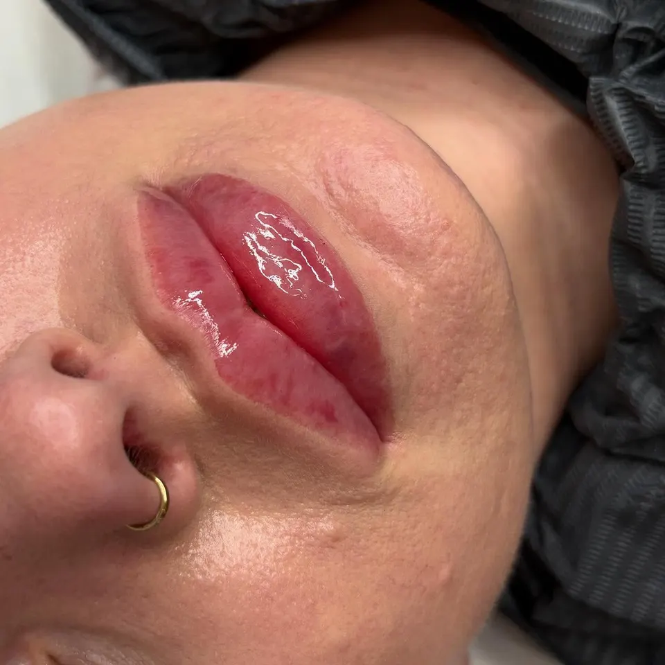 Lip enhancement