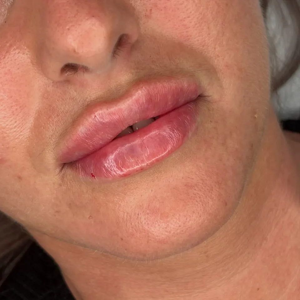 Subtle lip enhancement
